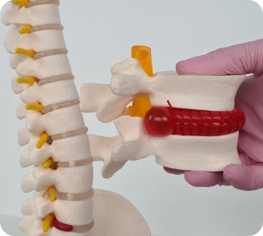 A doctor uses a model of a spine to show the bulge of a herniated disc